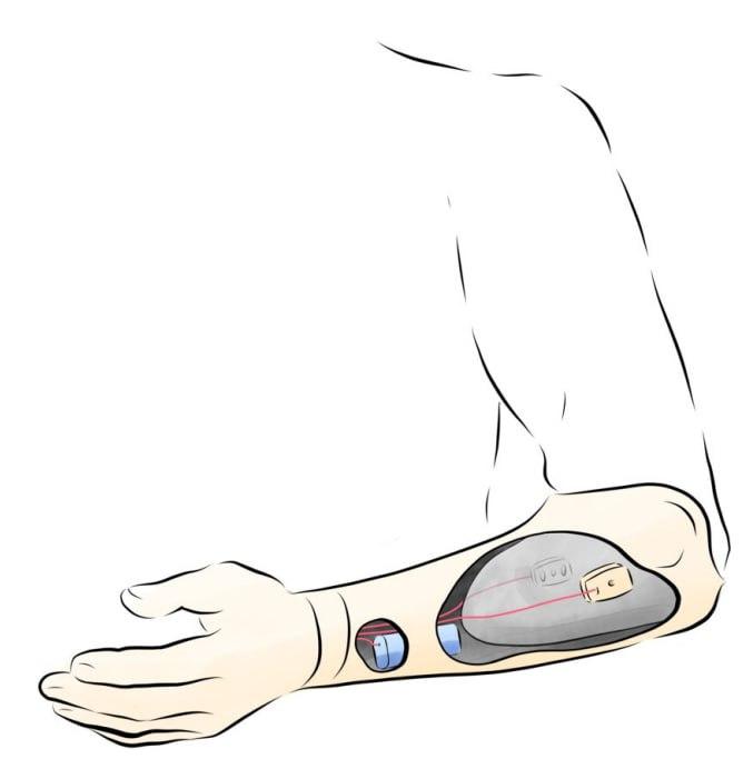 Steplife завершил тестирование датчиков EMG для протезов верхних конечностей